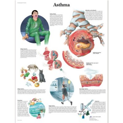Εκπαιδευτική αφίσα άσθματος 3B Scientific