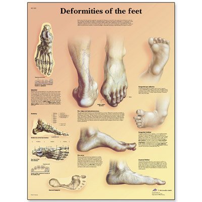 Εκπαιδευτική αφίσα παραμορφώσεων των ποδιών 3B Scientific