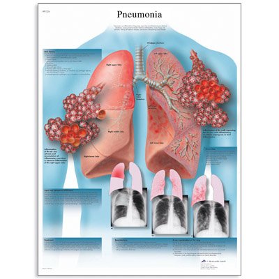 Εκπαιδευτική αφίσα πνευμονίας 3B Scientific